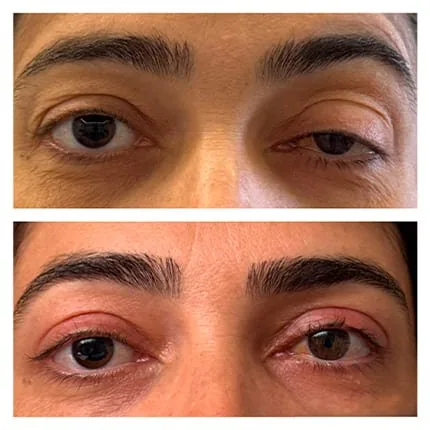 Antes e depois de blefaroplastia