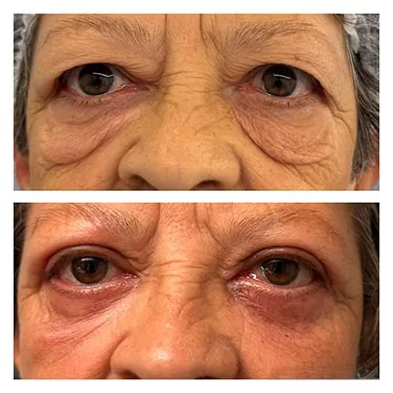 Antes e depois de blefaroplastia