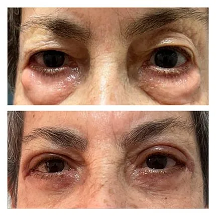 Antes e depois de blefaroplastia