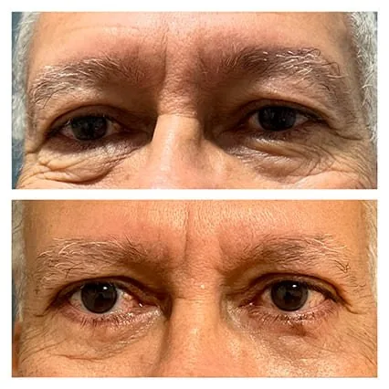 Antes e depois de blefaroplastia