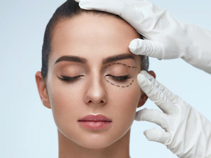 Quanto tempo dura a recuperação da Blefaroplastia?