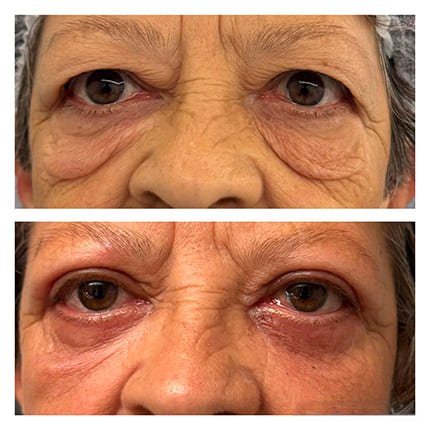 ex2 Blefaroplastia