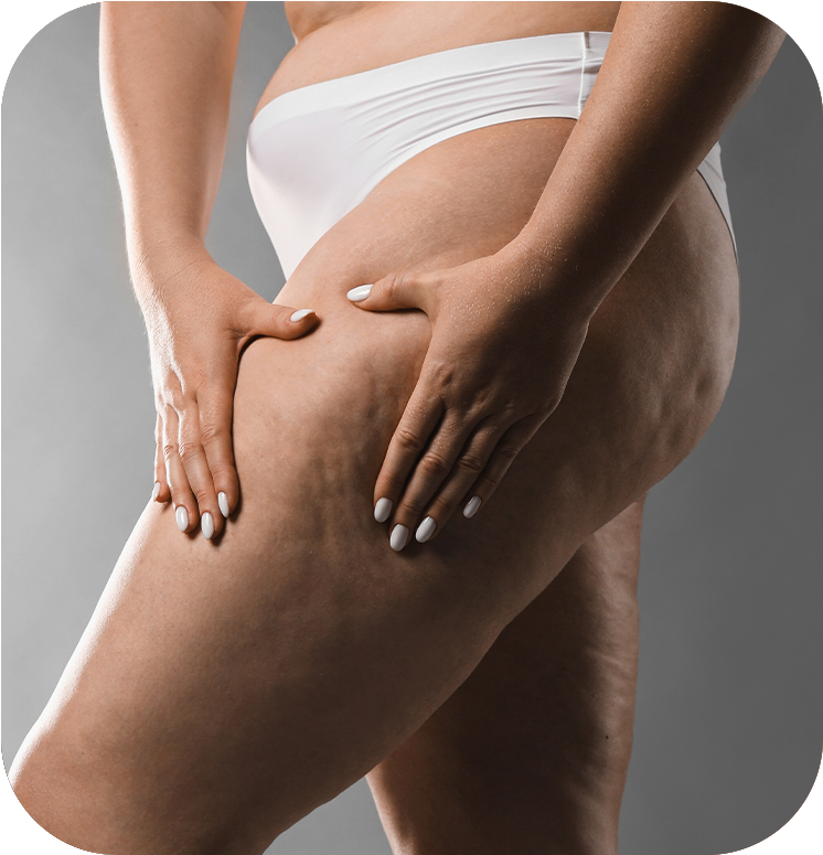 Lipedema Protocolo para Lipedema