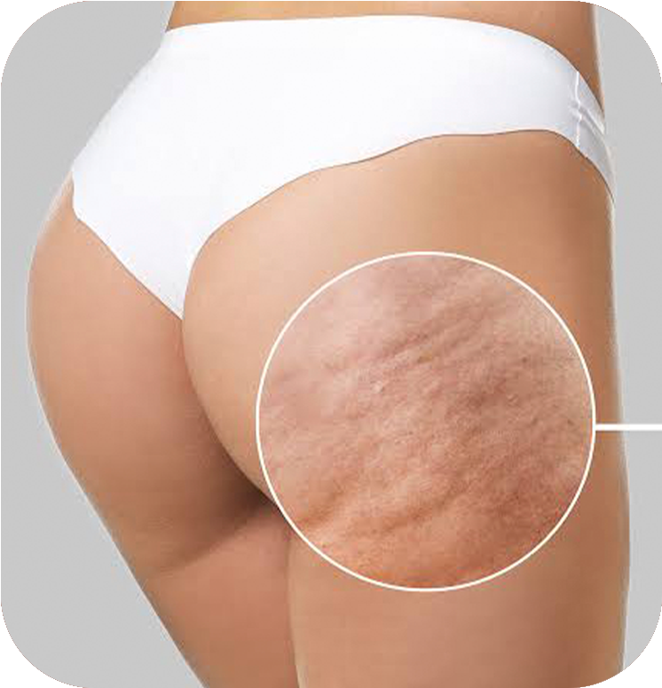 celulite Subcision