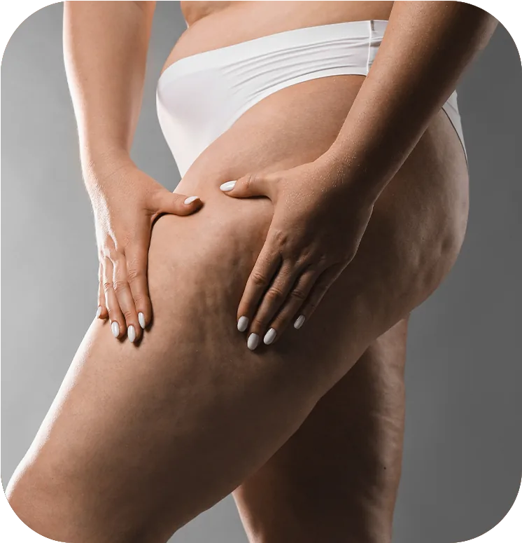 Protocolo para Lipedema em Uberlândia – MG